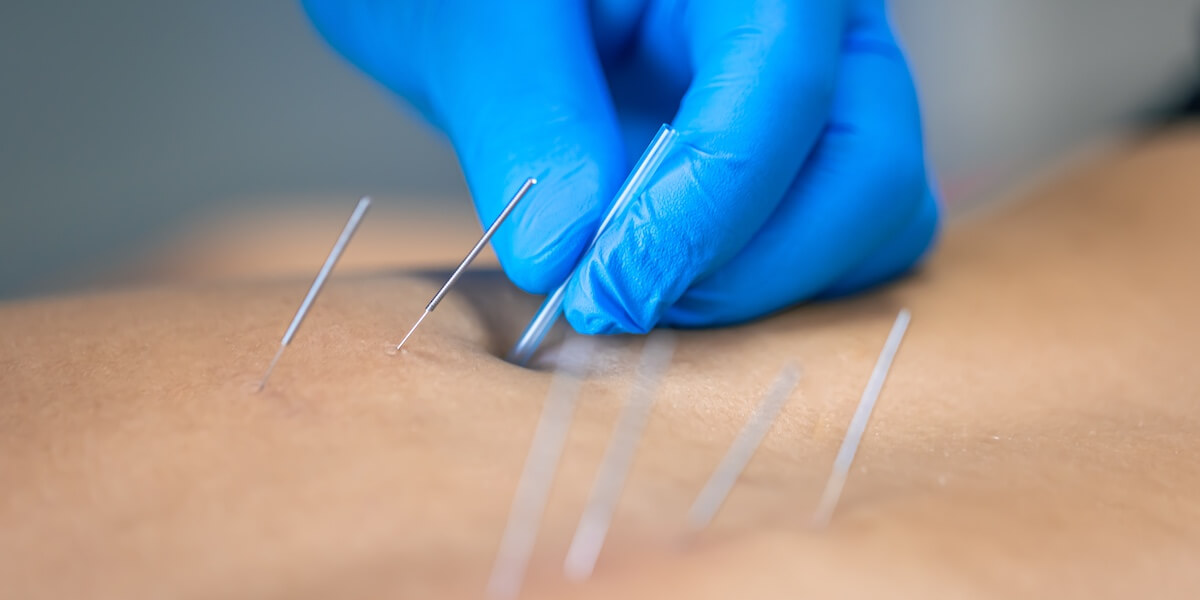 Dry-Needling and Electrotherapy service photo